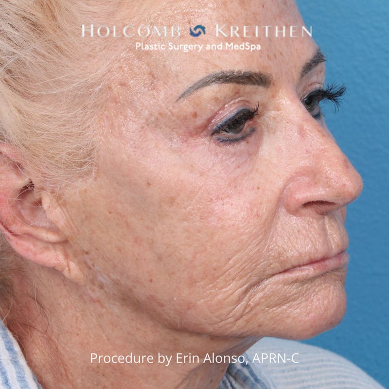 TRL Laser Skin Resurfacing Before & After Gallery - Patient 118342 - Image 3