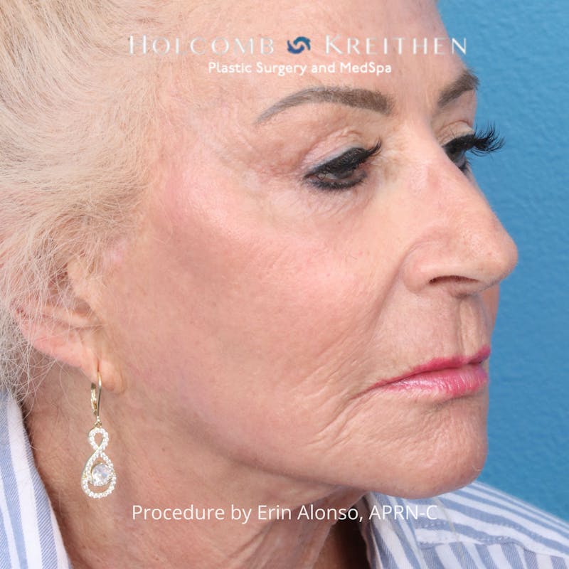 TRL Laser Skin Resurfacing Before & After Gallery - Patient 118342 - Image 4
