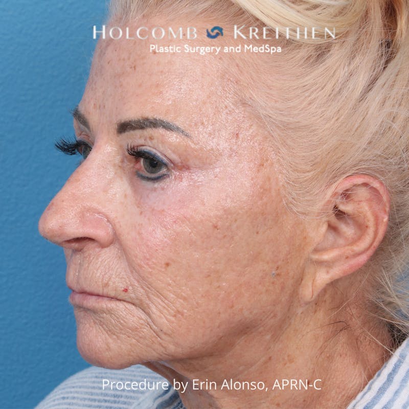 TRL Laser Skin Resurfacing Before & After Gallery - Patient 118342 - Image 5