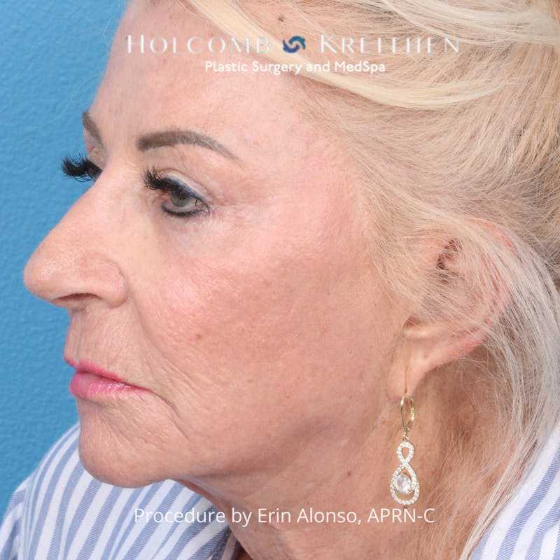 TRL Laser Skin Resurfacing Before & After Gallery - Patient 118342 - Image 6