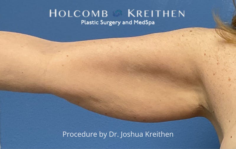 Arm Lift Before & After Gallery - Patient 327116 - Image 1