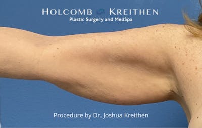 Arm Lift Before & After Gallery - Patient 327116 - Image 1