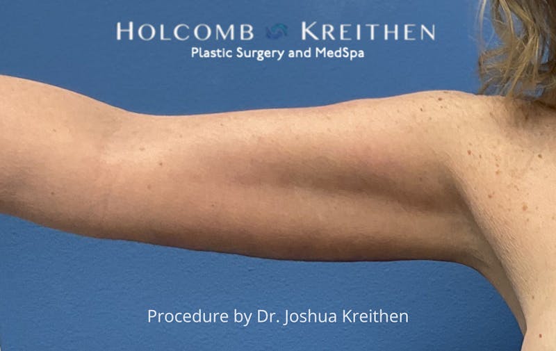 Arm Lift Before & After Gallery - Patient 327116 - Image 2