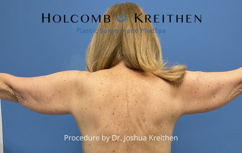 Arm Lift Before & After Gallery - Patient 327116 - Image 5