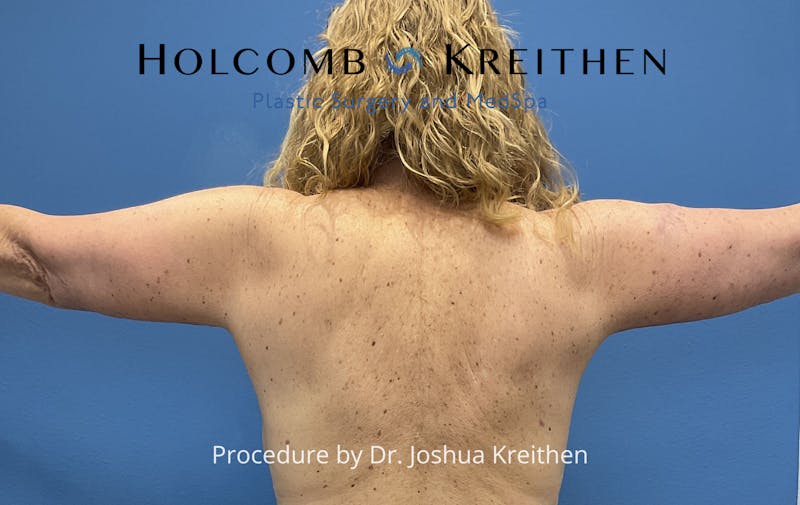 Arm Lift Before & After Gallery - Patient 327116 - Image 6