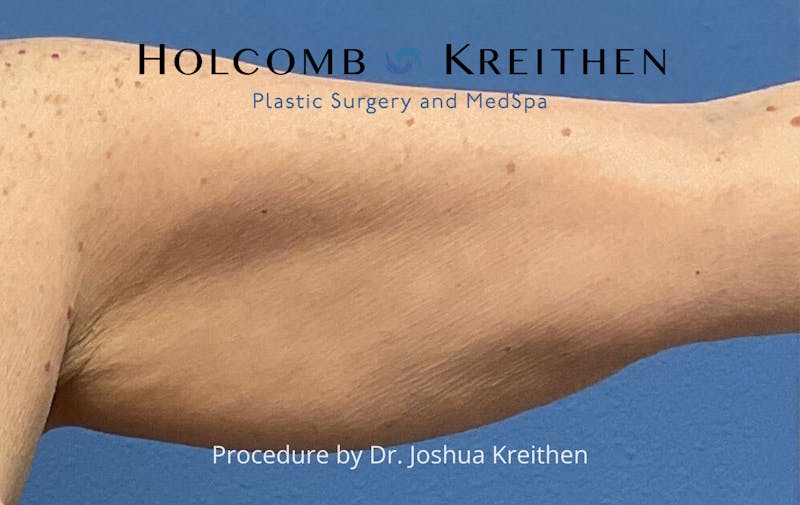 Arm Lift Before & After Gallery - Patient 327116 - Image 3