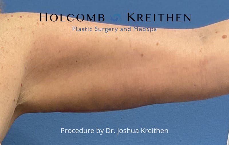 Arm Lift Before & After Gallery - Patient 327116 - Image 4