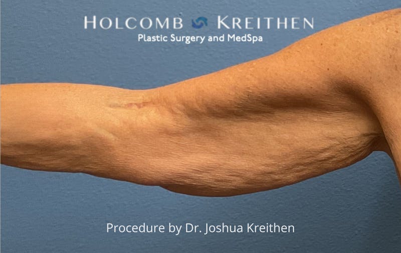 Arm Lift Before & After Gallery - Patient 601264 - Image 1