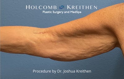 Arm Lift Before & After Gallery - Patient 601264 - Image 1