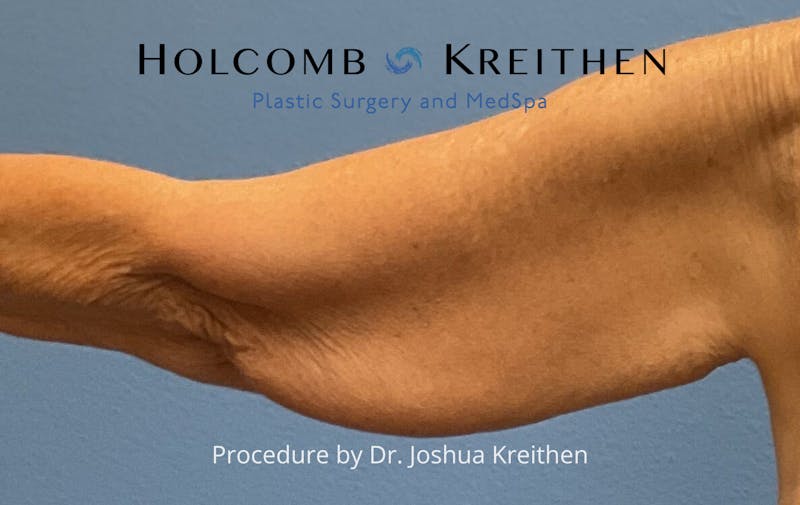 Arm Lift Before & After Gallery - Patient 601264 - Image 3