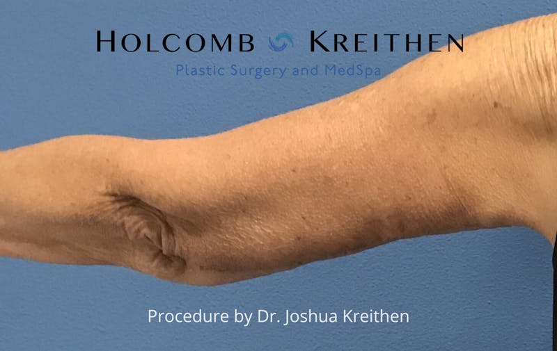 Arm Lift Before & After Gallery - Patient 601264 - Image 4