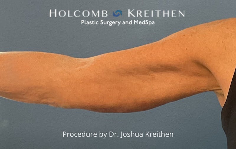 Arm Lift Before & After Gallery - Patient 601264 - Image 2