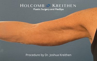 Arm Lift Before & After Gallery - Patient 601264 - Image 2