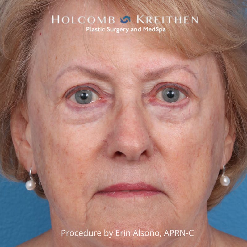 BBL Laser Before & After Gallery - Patient 171309 - Image 1