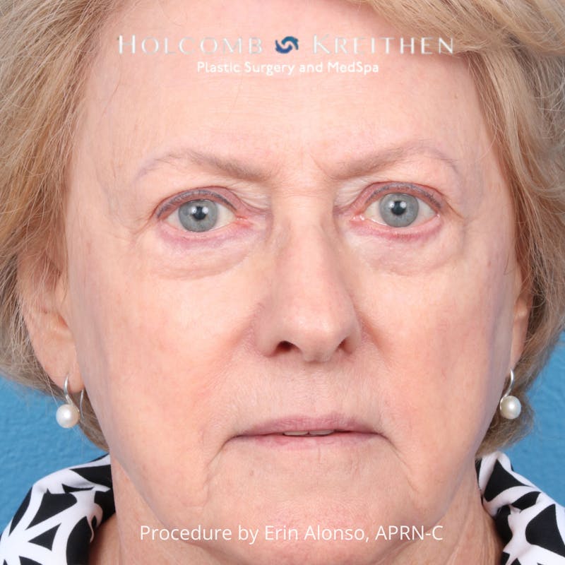 BBL Laser Before & After Gallery - Patient 171309 - Image 2