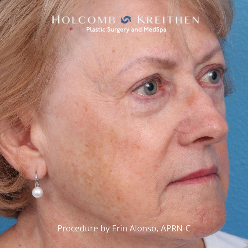 BBL Laser Before & After Gallery - Patient 171309 - Image 3