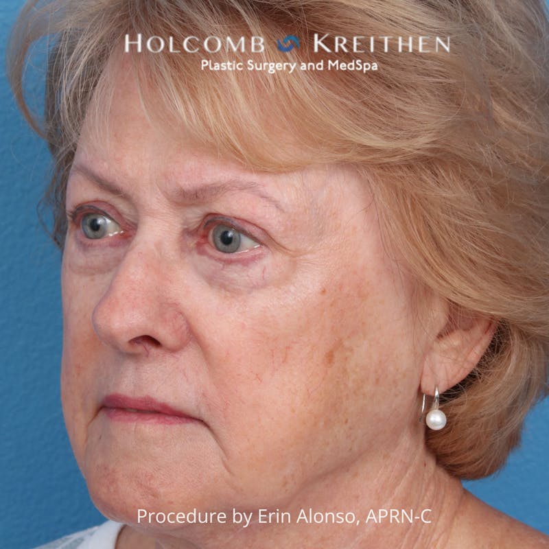 BBL Laser Before & After Gallery - Patient 171309 - Image 5