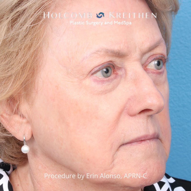 BBL Laser Before & After Gallery - Patient 171309 - Image 4