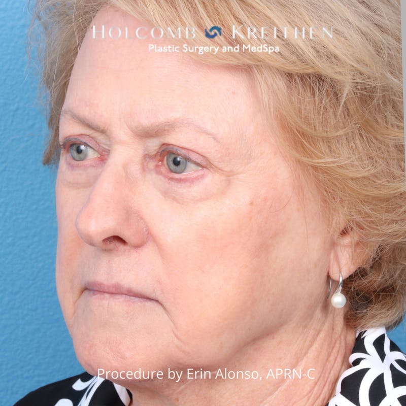BBL Laser Before & After Gallery - Patient 171309 - Image 6