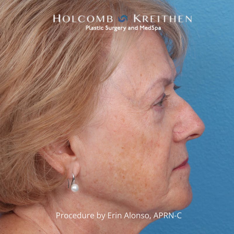 BBL Laser Before & After Gallery - Patient 171309 - Image 7