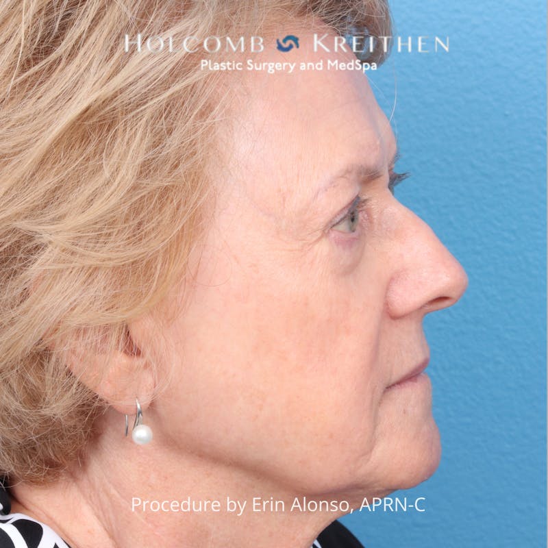 BBL Laser Before & After Gallery - Patient 171309 - Image 8