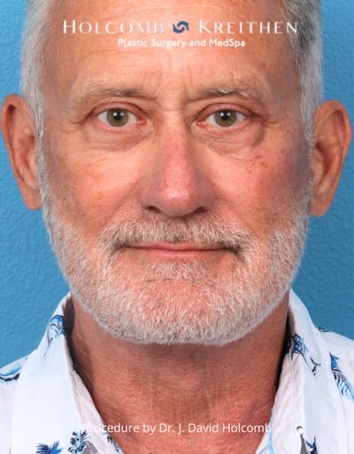 Blepharoplasty Before & After Gallery - Patient 367182 - Image 2
