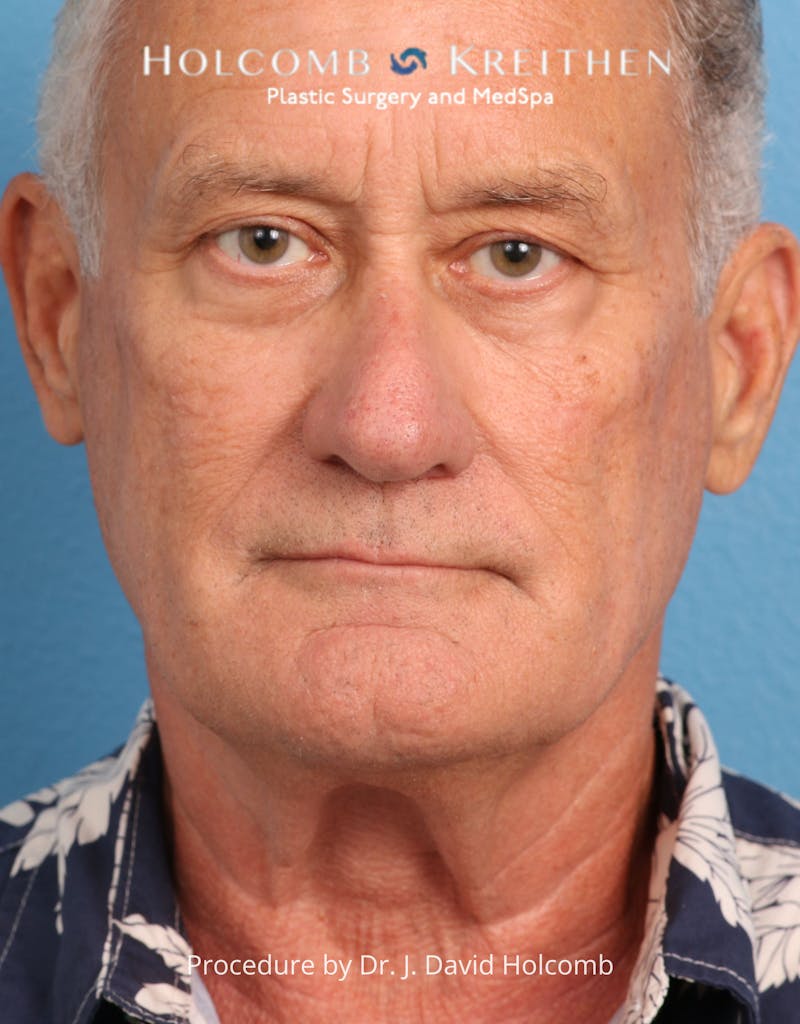 Blepharoplasty Before & After Gallery - Patient 367182 - Image 1