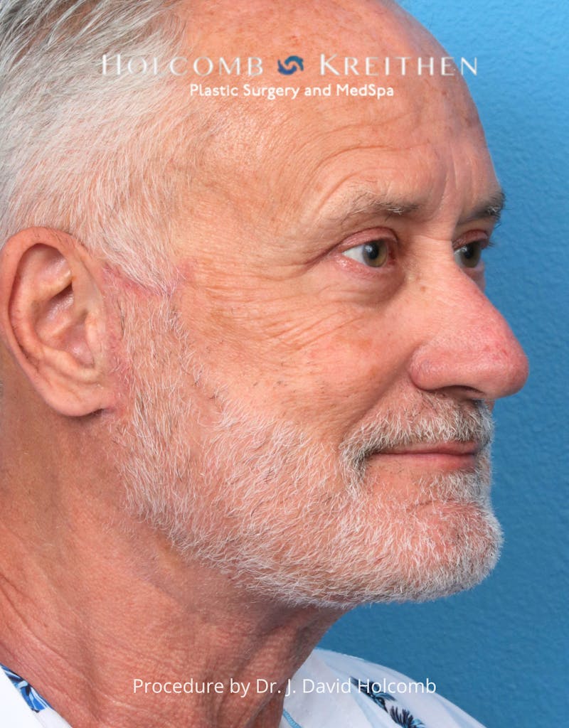 Blepharoplasty Before & After Gallery - Patient 367182 - Image 10