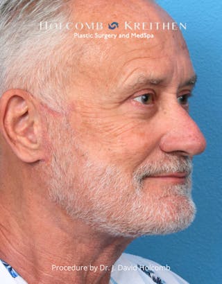 Facelift Before & After Gallery - Patient 740753 - Image 10