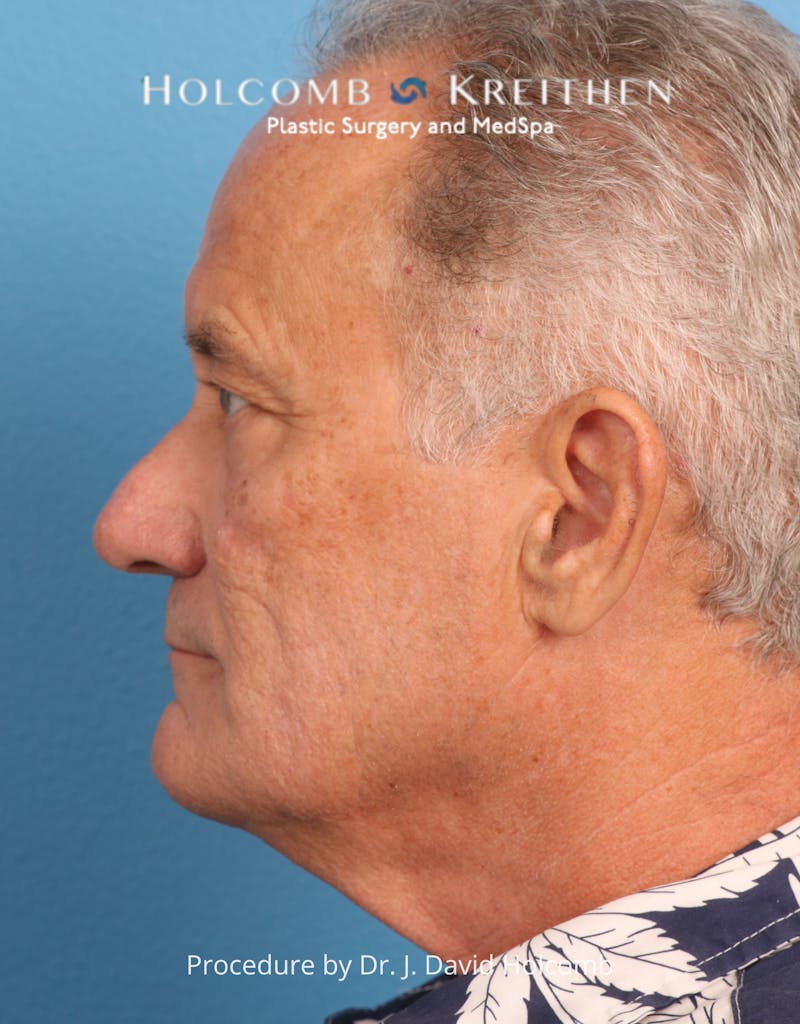 Blepharoplasty Before & After Gallery - Patient 367182 - Image 3