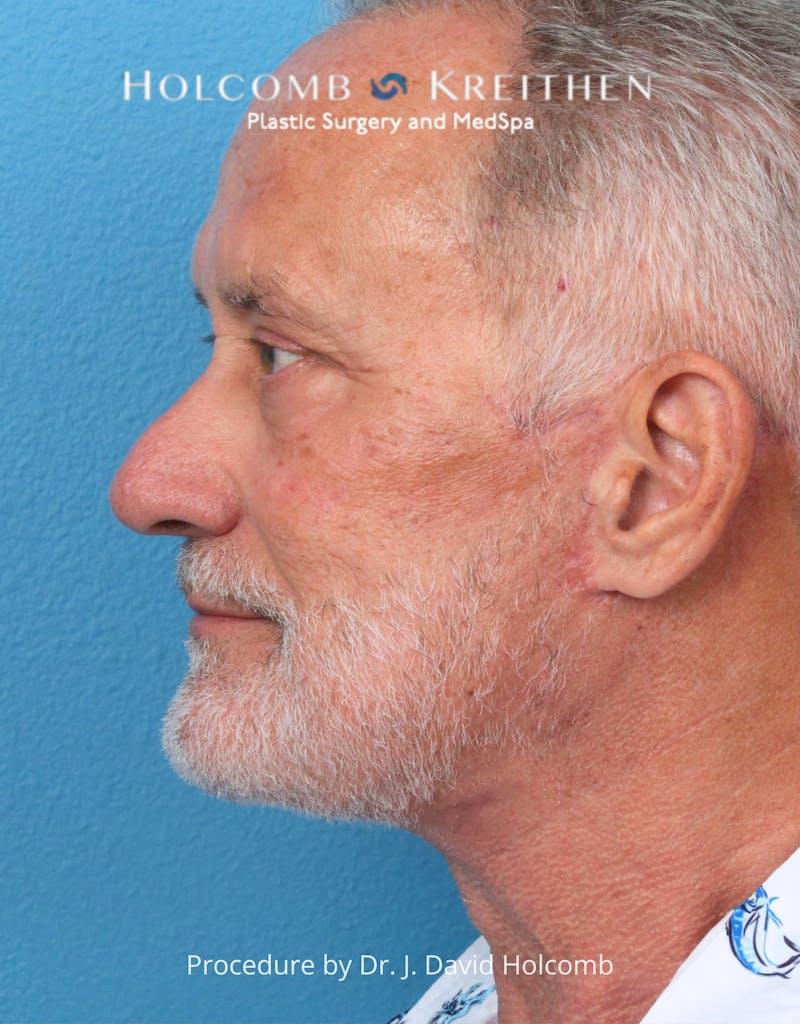 Blepharoplasty Before & After Gallery - Patient 367182 - Image 4
