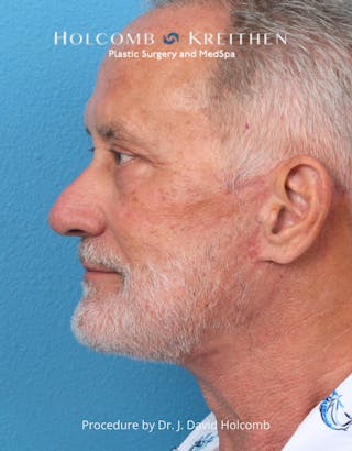 Facelift Before & After Gallery - Patient 740753 - Image 4