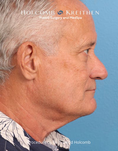 Neck Contouring Before & After Gallery - Patient 336499 - Image 1