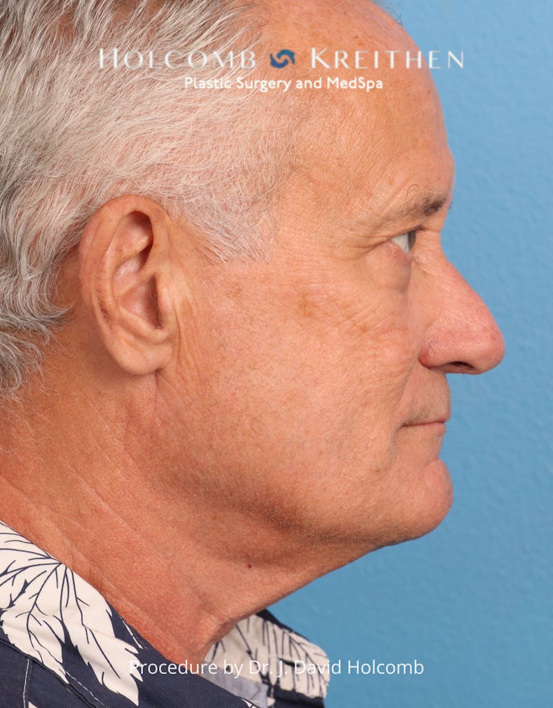 Blepharoplasty Before & After Gallery - Patient 367182 - Image 5