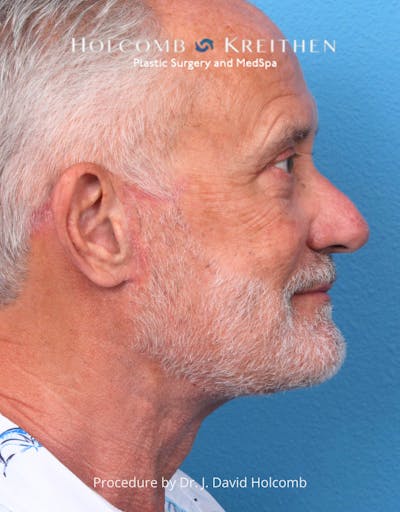 Neck Contouring Before & After Gallery - Patient 336499 - Image 2