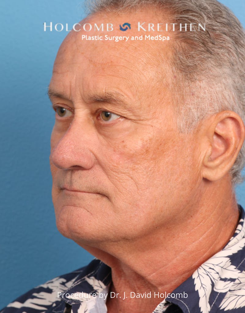 Blepharoplasty Before & After Gallery - Patient 367182 - Image 7