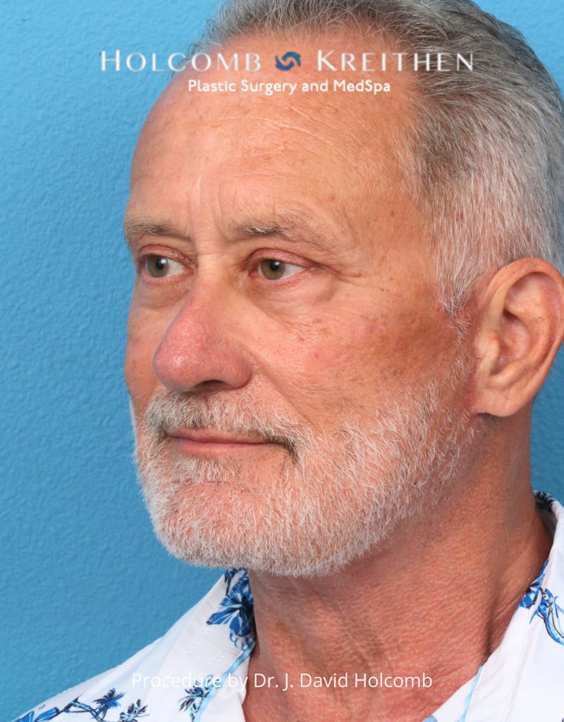 Blepharoplasty Before & After Gallery - Patient 367182 - Image 8