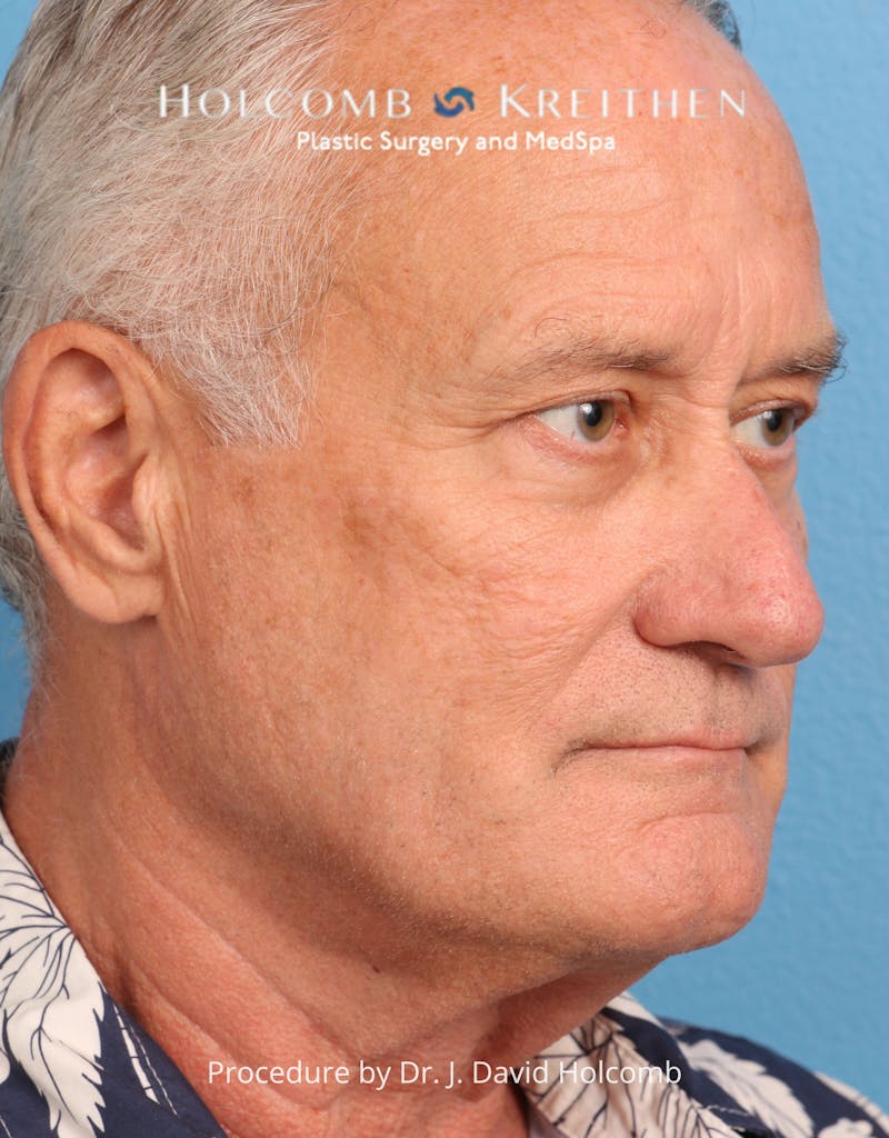 Blepharoplasty Before & After Gallery - Patient 367182 - Image 9