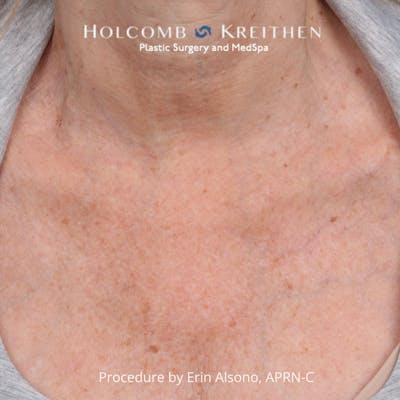 Ultraclear Before & After Gallery - Patient 388187 - Image 1
