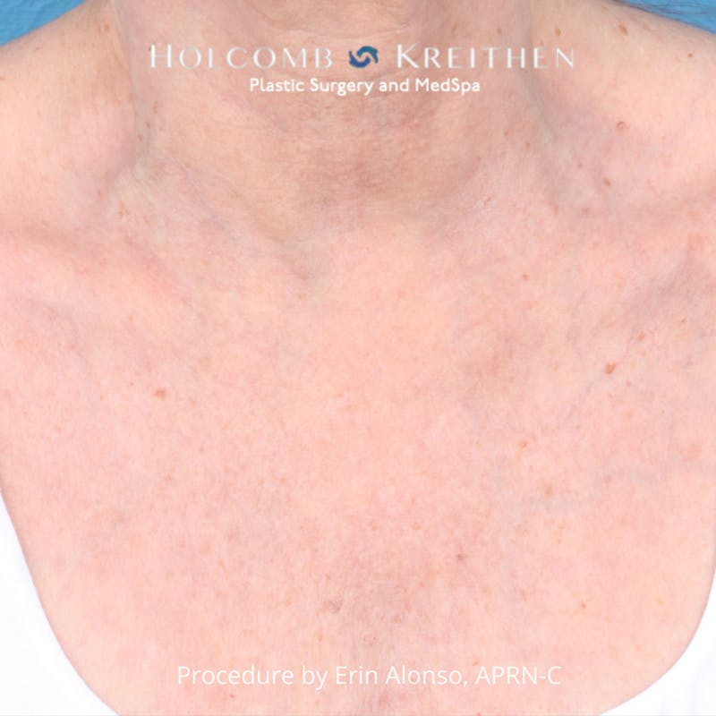 Ultraclear Before & After Gallery - Patient 388187 - Image 2