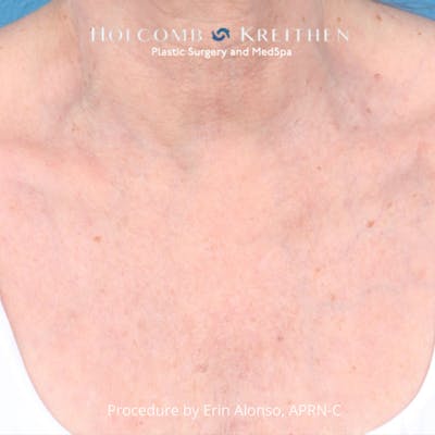 Ultraclear Before & After Gallery - Patient 388187 - Image 2