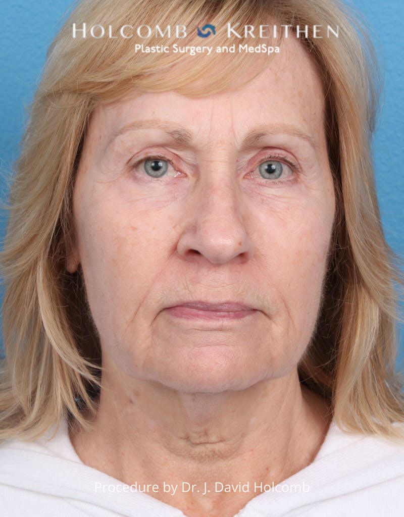 Facelift Before & After Gallery - Patient 284851 - Image 1