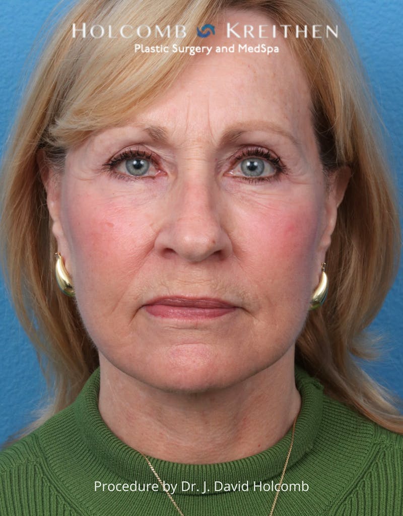 Facelift Before & After Gallery - Patient 284851 - Image 2