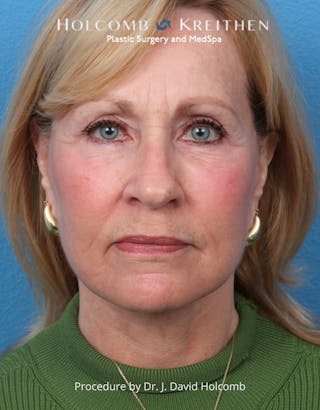 Facelift Before & After Gallery - Patient 284851 - Image 2