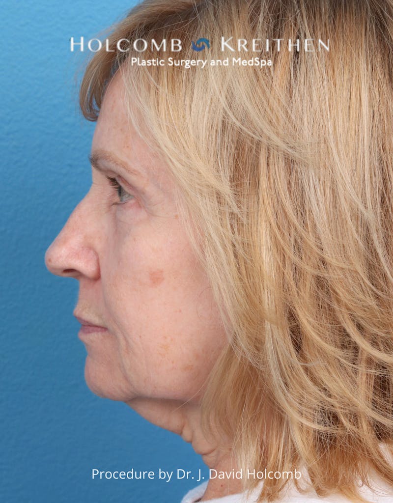 Facelift Before & After Gallery - Patient 284851 - Image 3