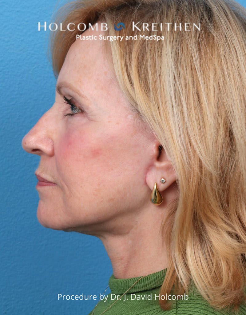 Facelift Before & After Gallery - Patient 284851 - Image 4