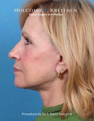 Facelift Before & After Gallery - Patient 284851 - Image 4