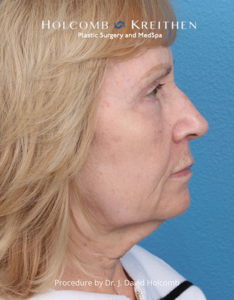Facelift Before & After Gallery - Patient 284851 - Image 5