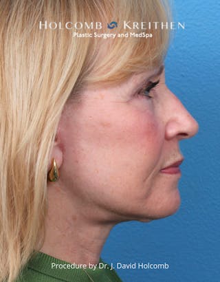 Facelift Before & After Gallery - Patient 284851 - Image 6