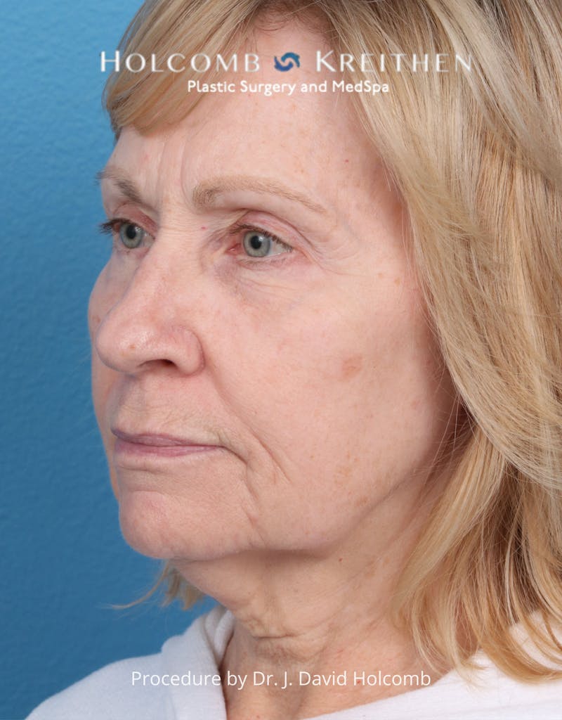 Facelift Before & After Gallery - Patient 284851 - Image 7